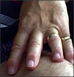 photo of Bernards hand